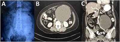 Huge Retroperitoneal Cyst Masquerading as Ovarian Tumour: A Case Report